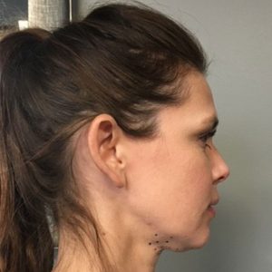 kybella-2nd-patient-before-updated