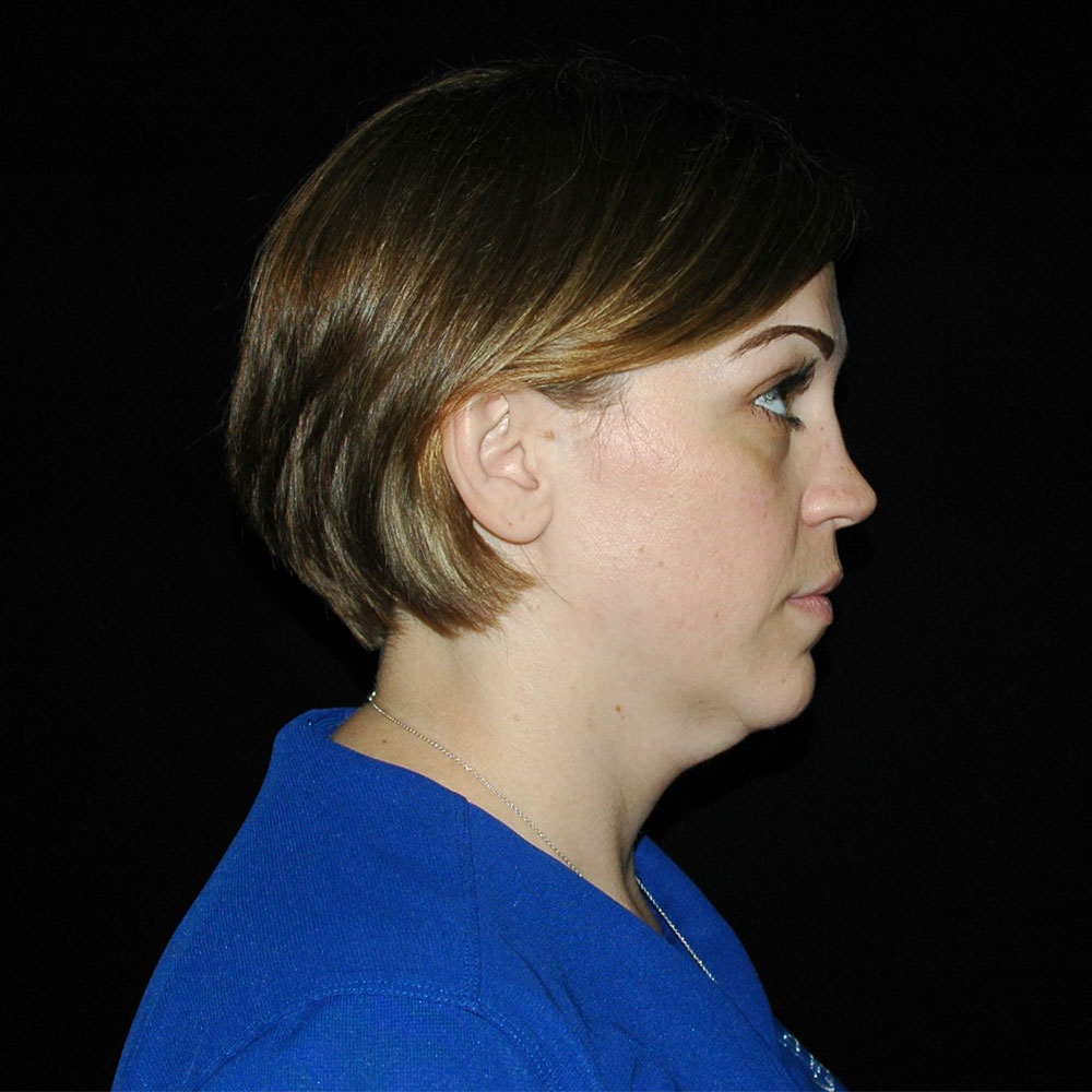 kybella-side-after-1-treatment-updated