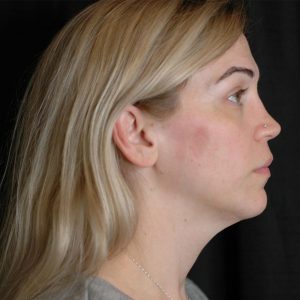 kybella-side-after-3-treatment-updated