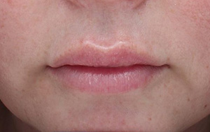 RHA after cp lips (2)