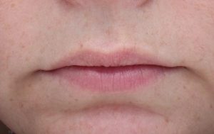 RHA before cp lips (2)
