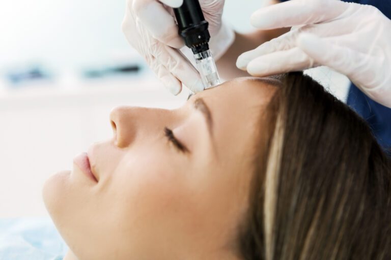 Woman receives microneedling treatment on her forehead