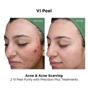 VI Peel_Acne_Purify With PP