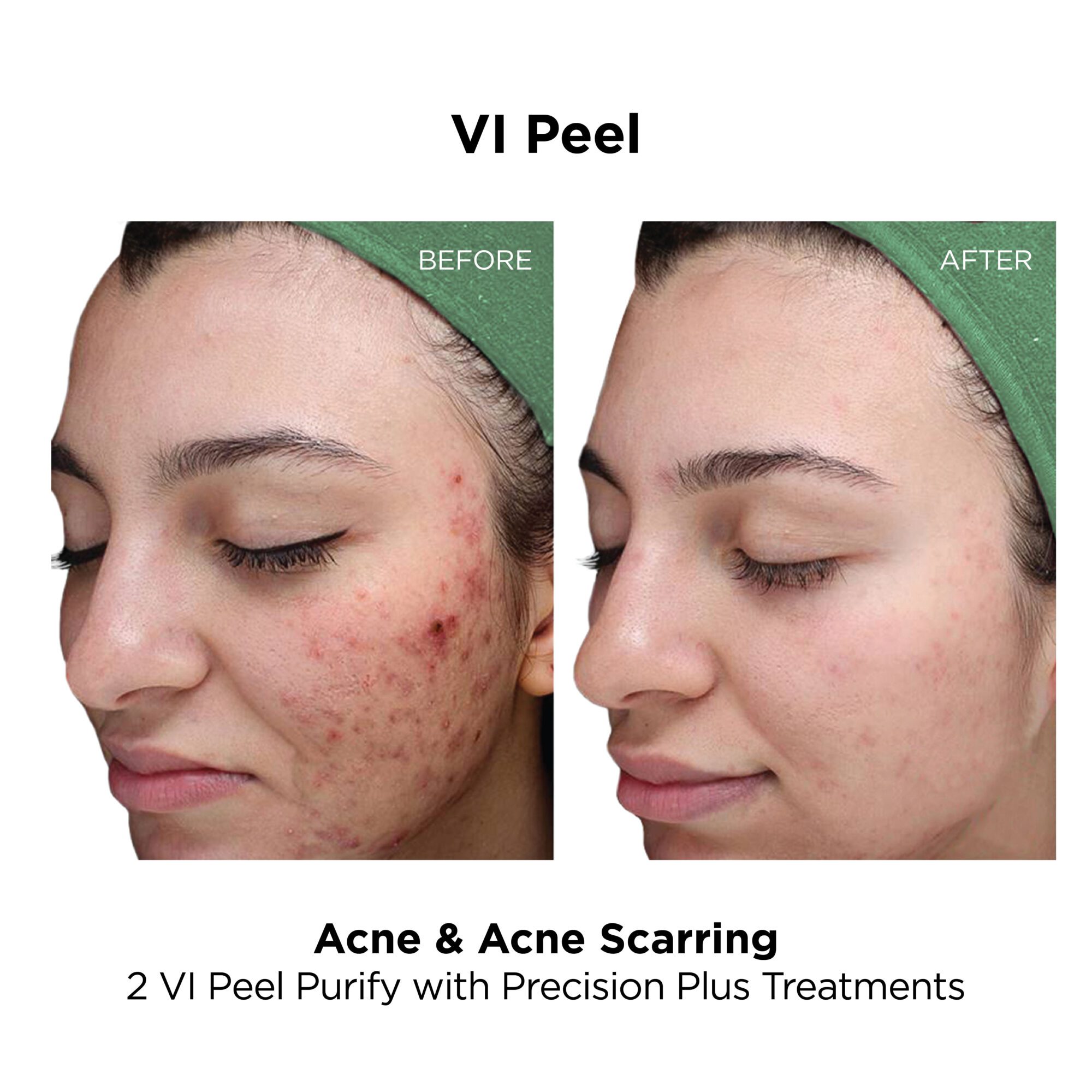 VI Peel_Acne_Purify With PP