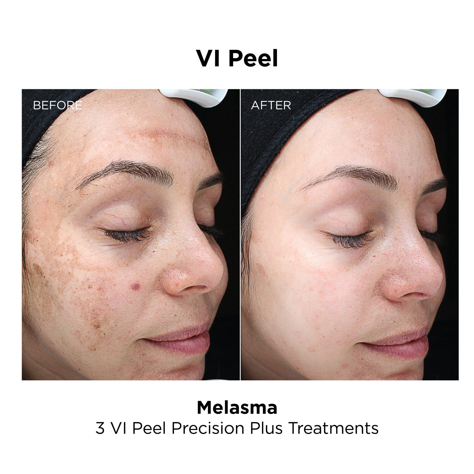 VI Peel_Melasma_Precision Plus
