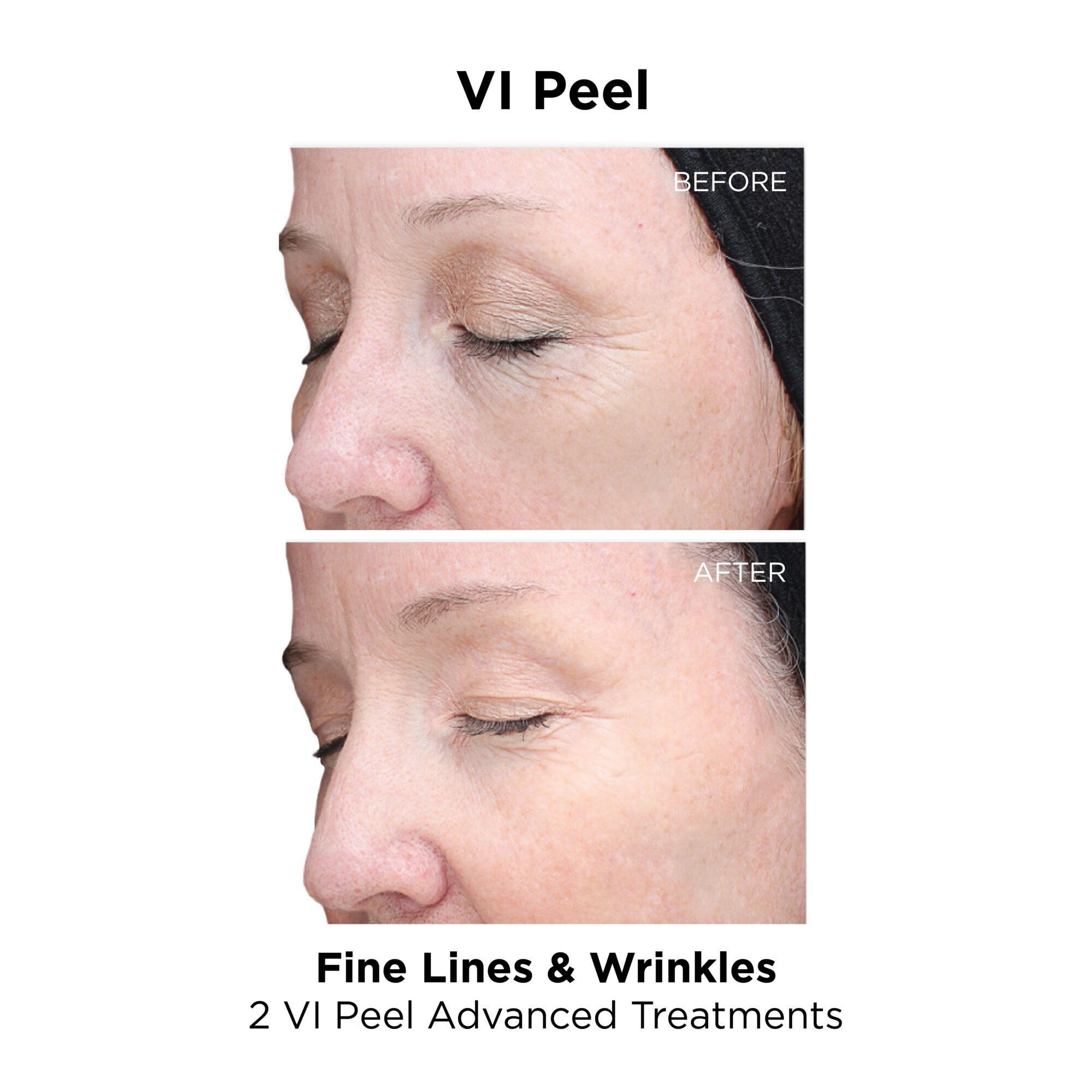 VI Peel_Wrinkles_Advanced