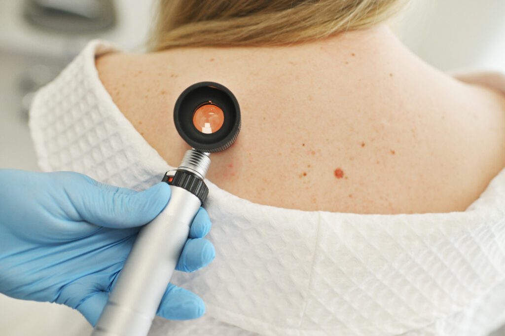 Dermatologist examning moles and skin growth on the patients body.