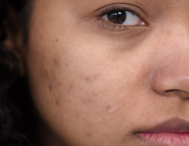 Young female face with acne