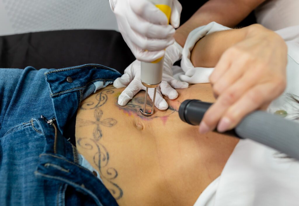 laser tattoo removal in process