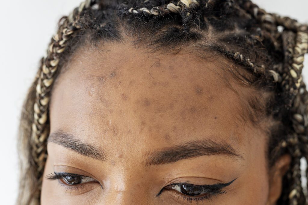 Close-up of hormonal acne on a woman’s face