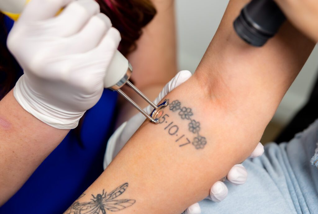 An Astanza machine removing a tattoo on a forearm